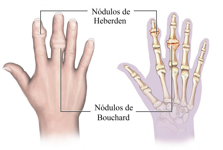 artrosis pulgar rizartrosis 2